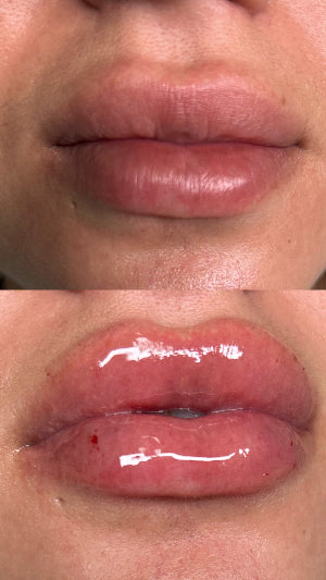 Needless Lip Fillers