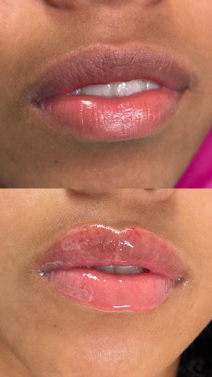 Needless Lip Fillers