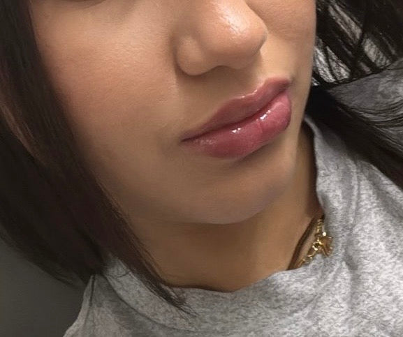 Needless Lip Fillers