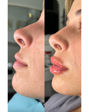 Needless Lip Fillers